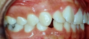 Casos Clínicos-Egos Clínica Odontológica-Curitiba-Implantes_Dr Eurides_dentista_curitiba_Eurides Gurkewicz_Alexandre_01
