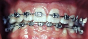 Casos Clínicos-Egos Clínica Odontológica-Curitiba-Implantes_Dr Eurides_dentista_curitiba_Eurides Gurkewicz_Alexandre_02